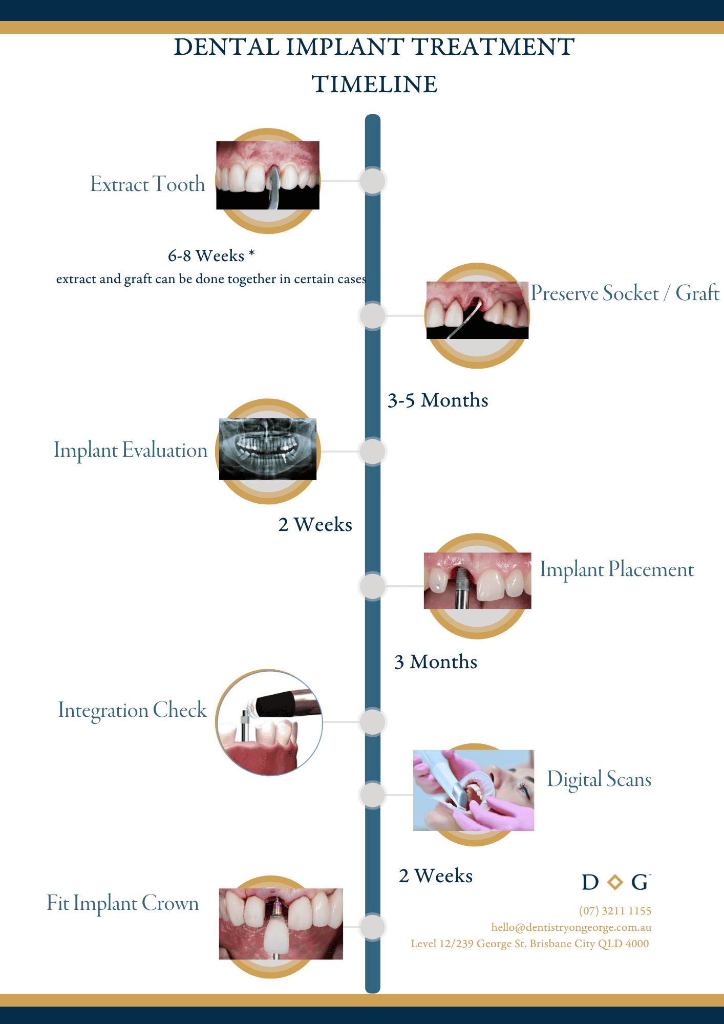 Dental Implant Treatment Timeline Dental Implant Timeline
