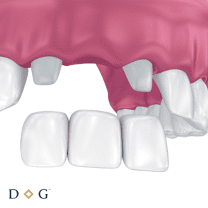 Dental Bridges