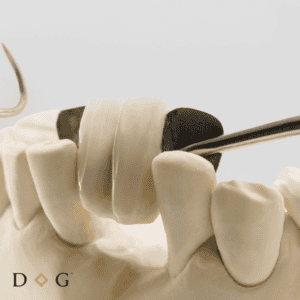 Adhesive bridge